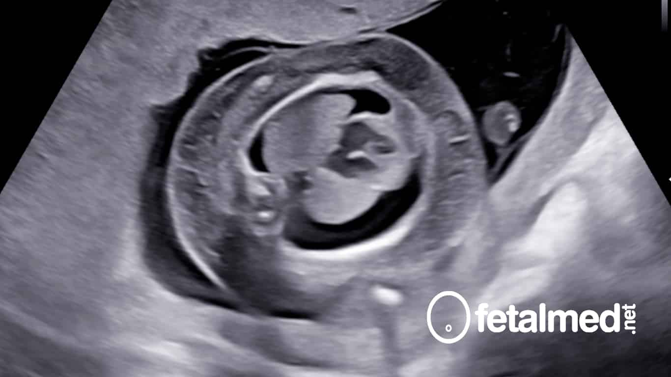 Escore cardiovascular na vigilância de fetos hidrópicos