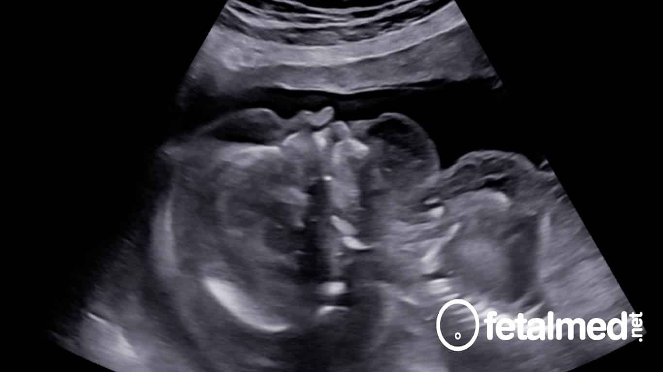 Hidropsia fetal: o que é e como tratar