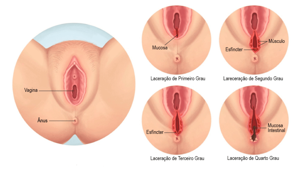 Tipos de Laceração Perineal
