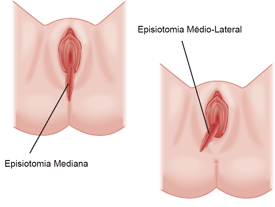 Tipos de Episiotomia