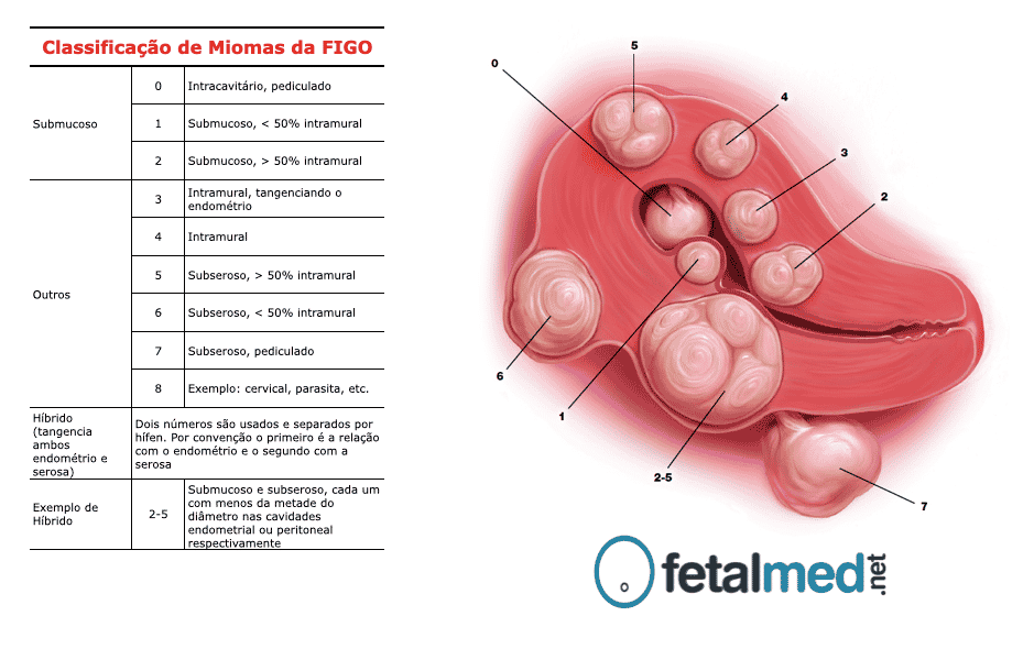 Classificação de Leiomiomas segundo FIGO