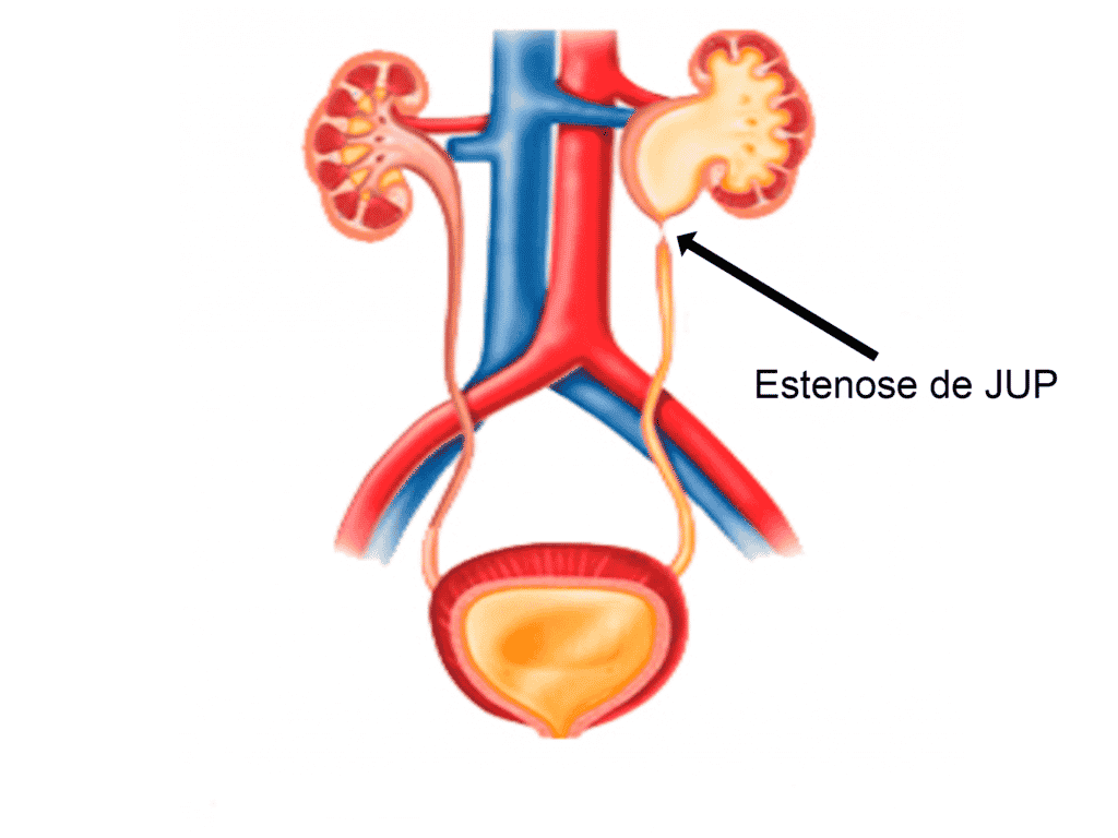 Estenose de JUP
