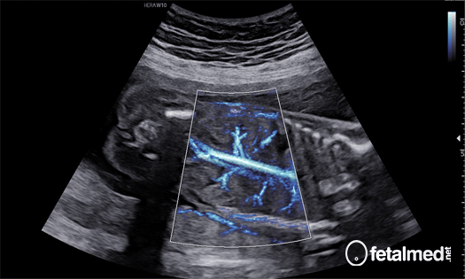 Ultrassom com Doppler: o que é e como é usado na gestação