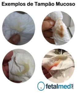 O que é tampão mucoso e o que ele faz? | Fetalmed