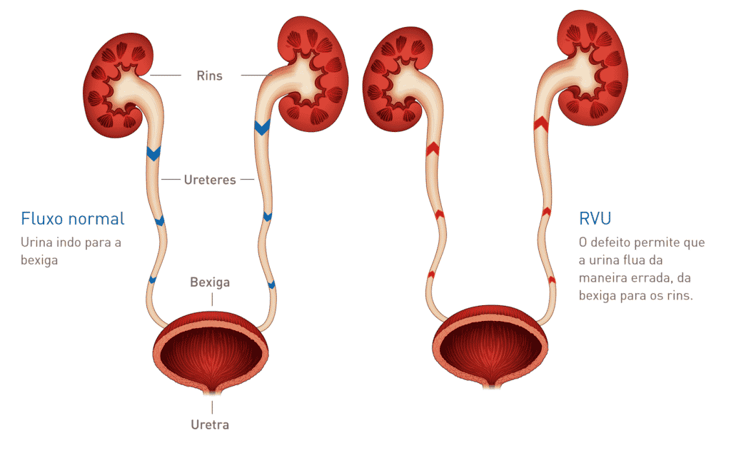 Refluxo Vésico-Ureteral