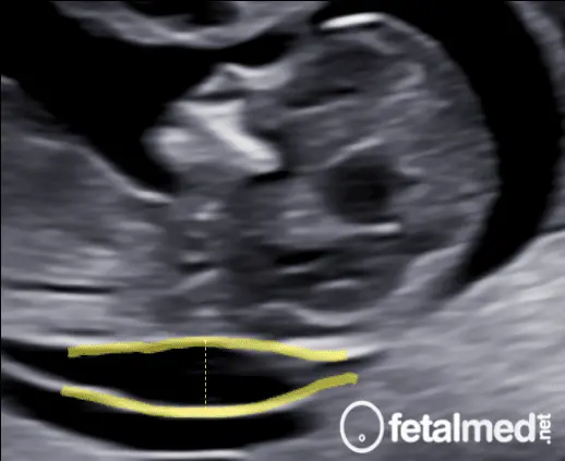 Ultrassom mostrando translucência nucal aumentada acima do percentil 95 — indicação de investigação complementar