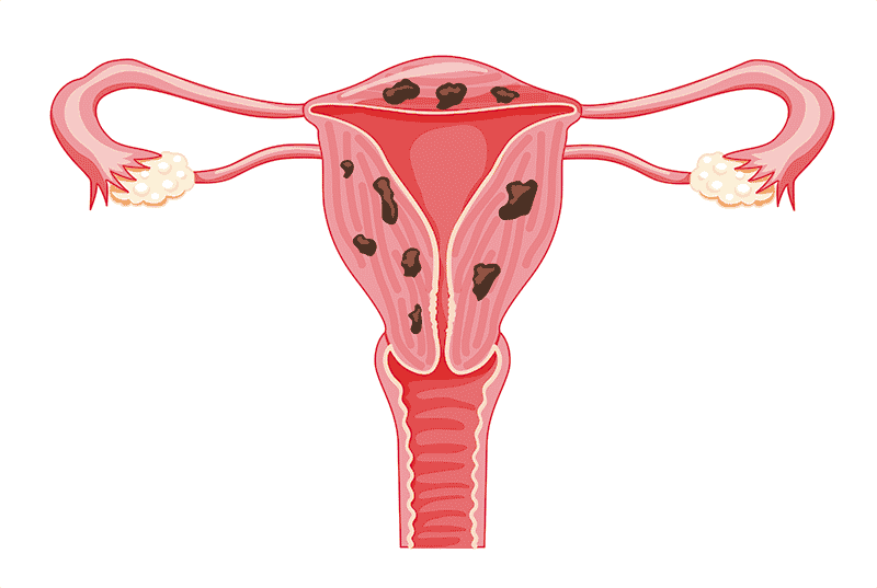 Adenomiose: uma doença que você nunca ouviu falar, mas deveria conhecer