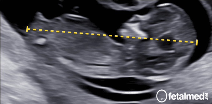 O que é a medida do CCN Fetal