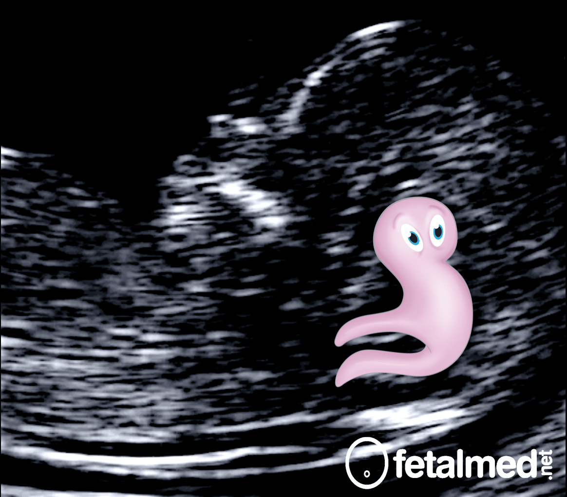 Sinal do Polvo na Translucência Intracraniana