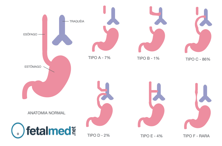 Tipos de Atresia de Esôfago
