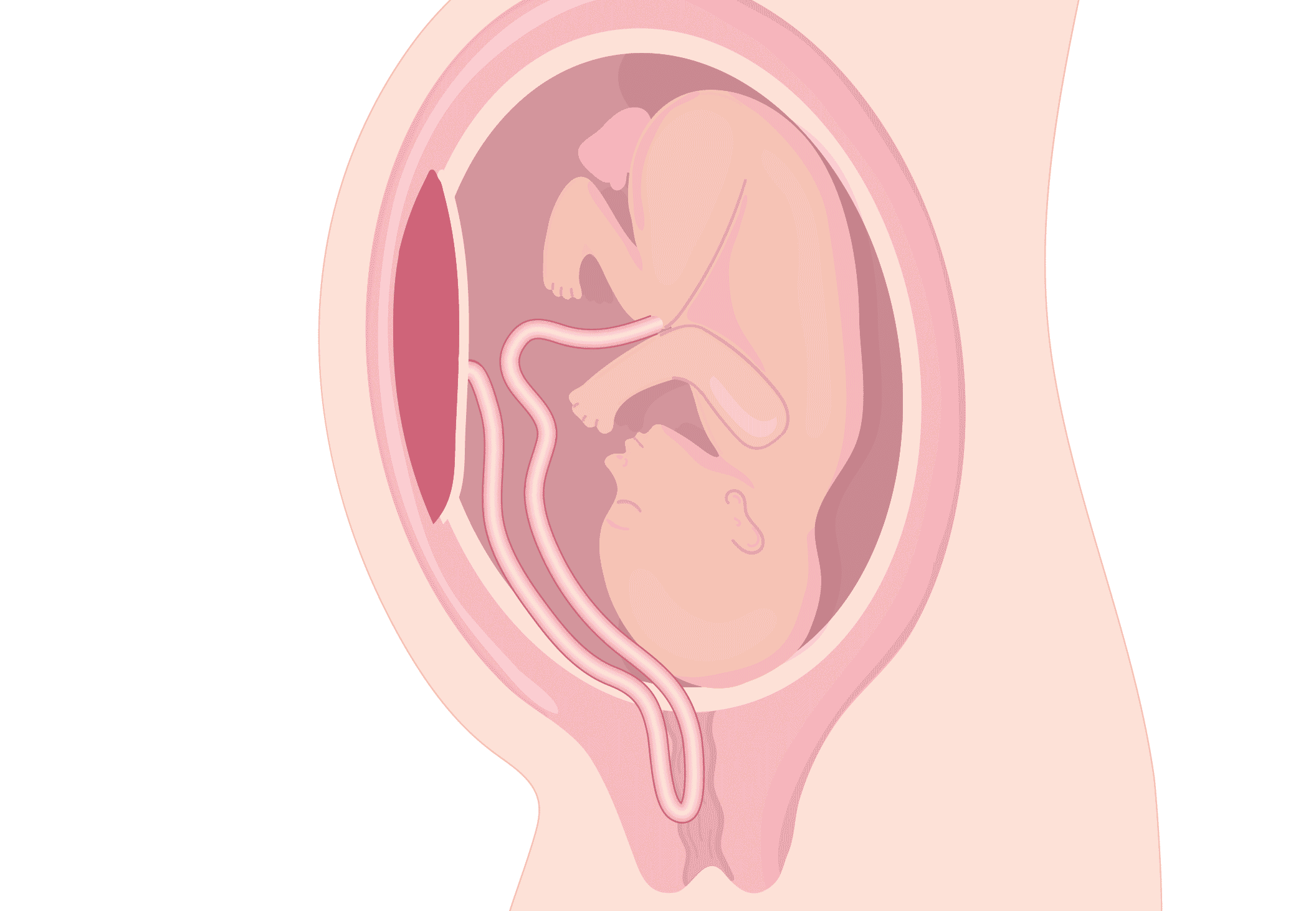 O que é prolapso de cordão umbilical?