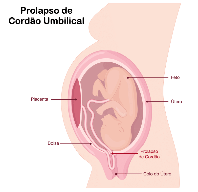 Prolapso de Cordão Umbilical