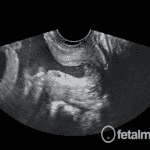 Tabela Comprimento Colo Uterino