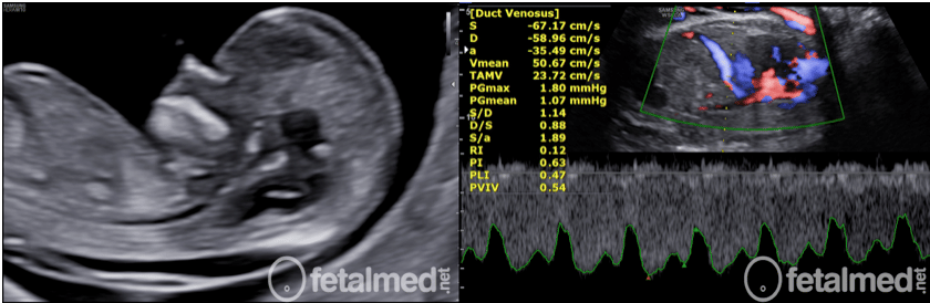 Translucência Nucal e Ducto Venoso