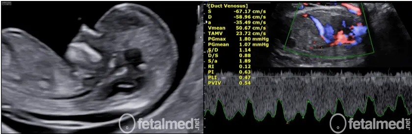 Comparação entre translucência nucal e Doppler do ducto venoso no exame morfológico de primeiro trimestre