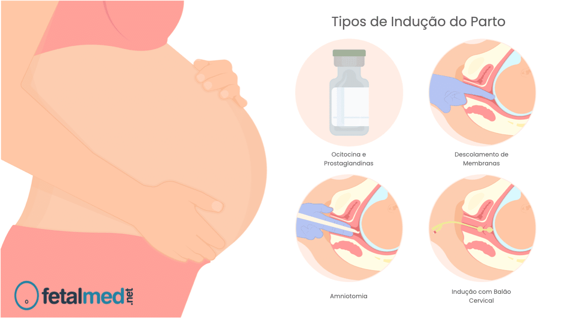 Tipos de Indução do Trabalho de Parto