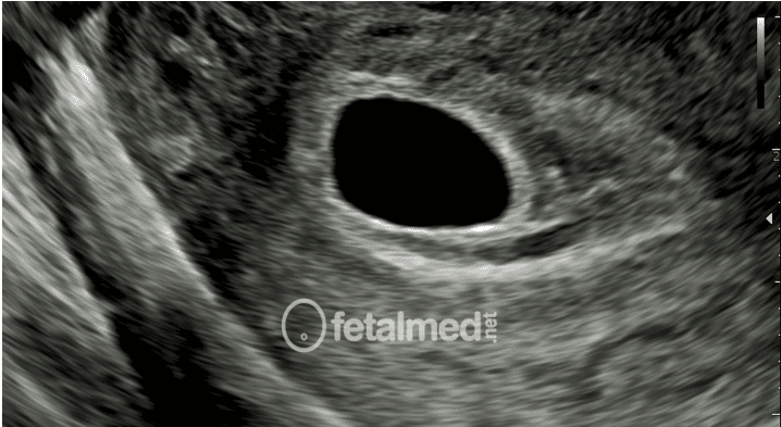 Gravidez Anembrionária