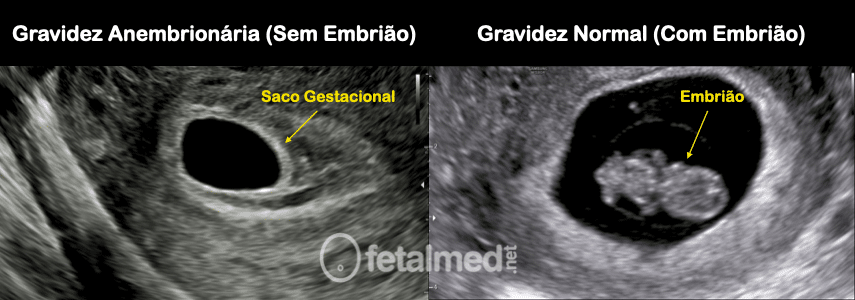 Gravidez Anembrionária