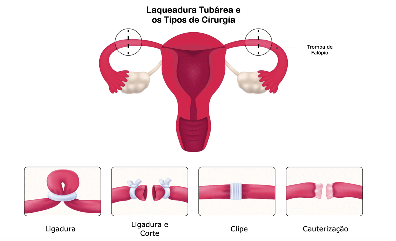 Tipos de Laqueadura Tubárea