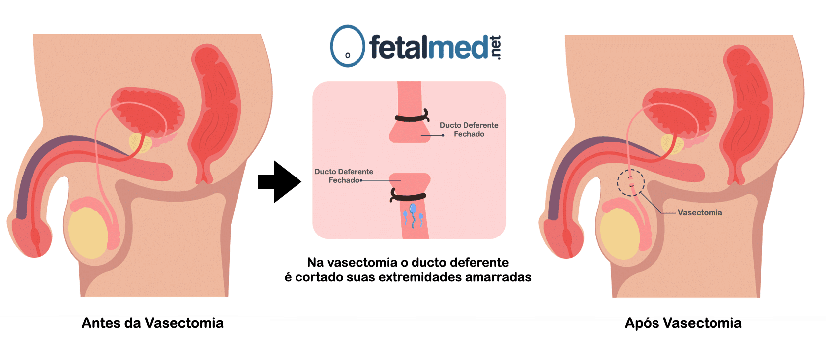 Vasectomia Como é Realizada