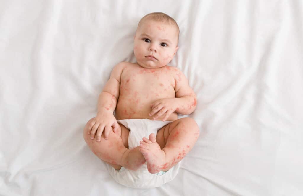 Manchas Vermelhas na Pele do Bebê: o que toda mamãe precisa saber
