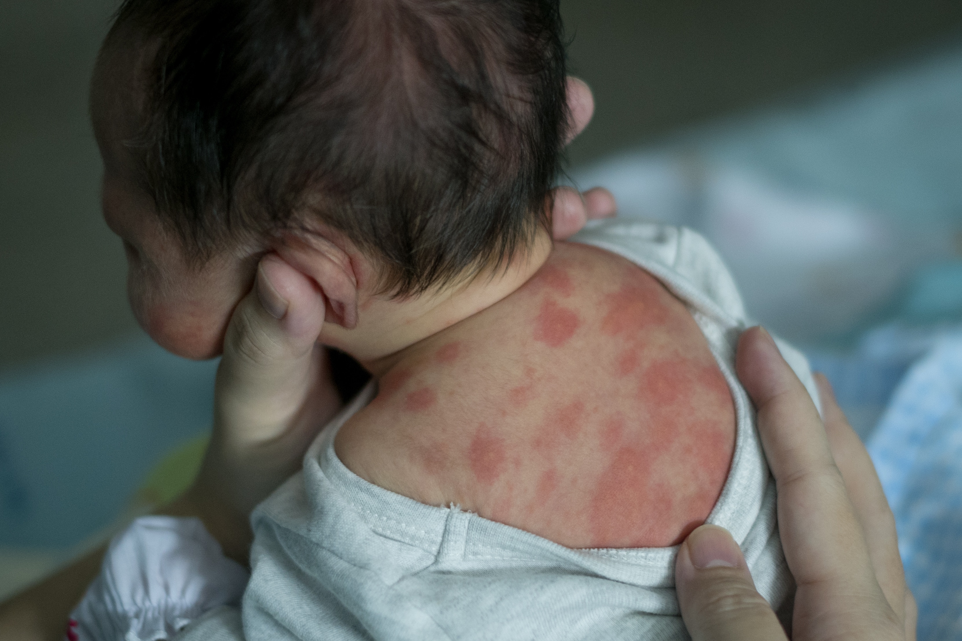Manchas Vermelhas na Pele do Bebê: o que toda mamãe precisa saber