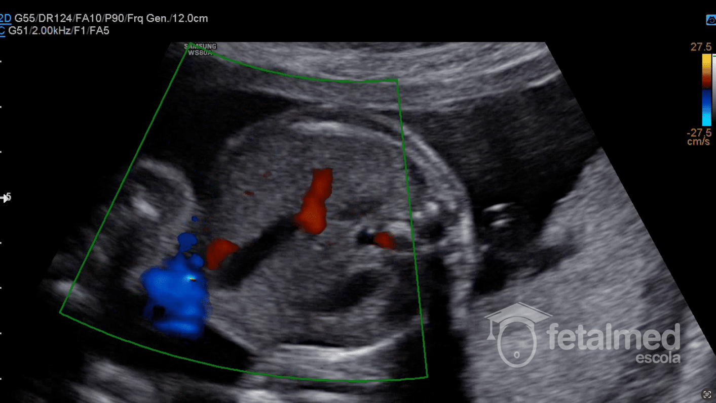 Veia Umbilical Direita Persistente