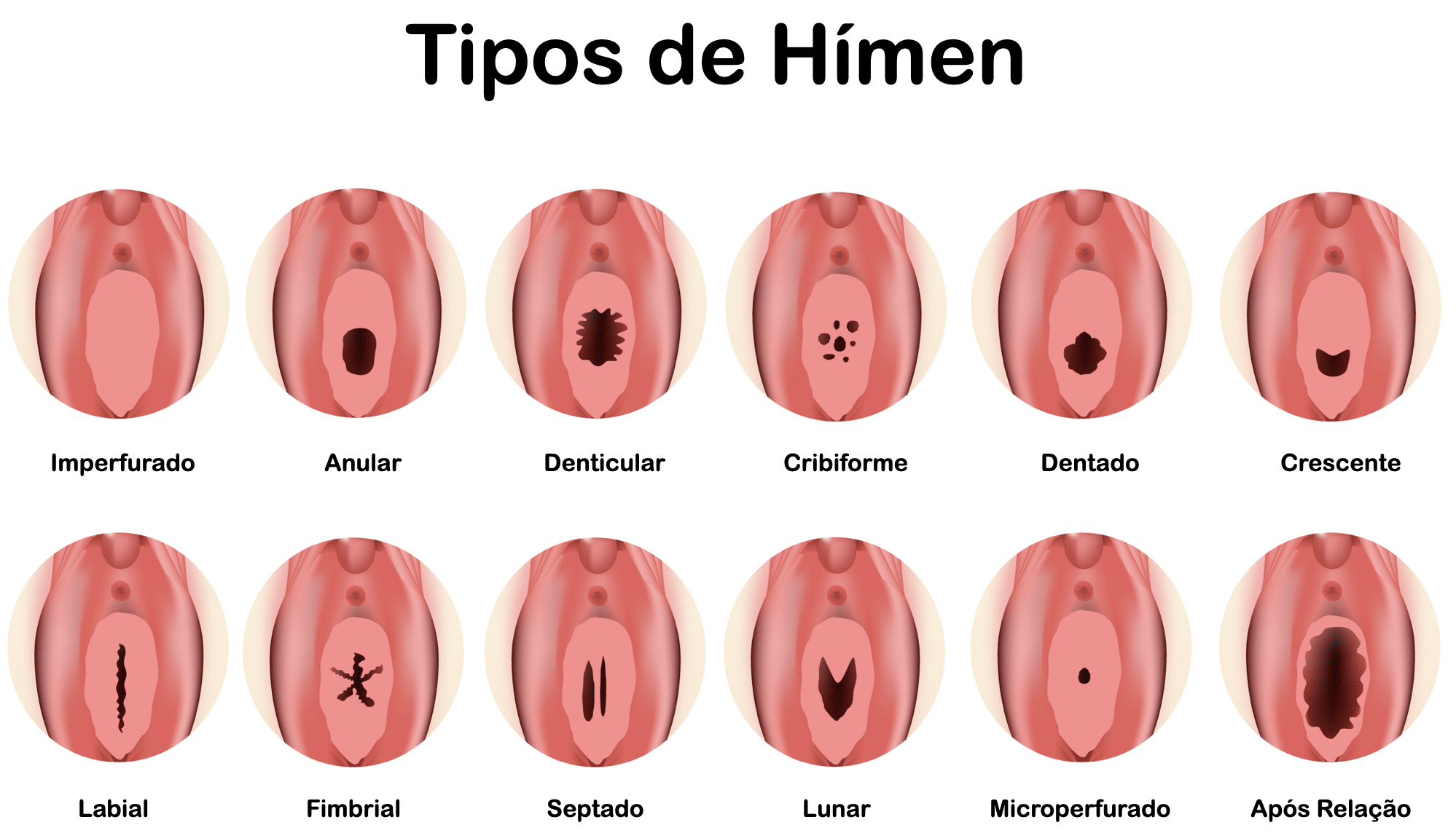 Tipos de Hímen