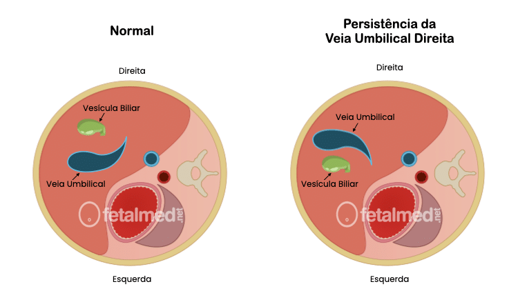 Veia Umbilical Direita Persistente