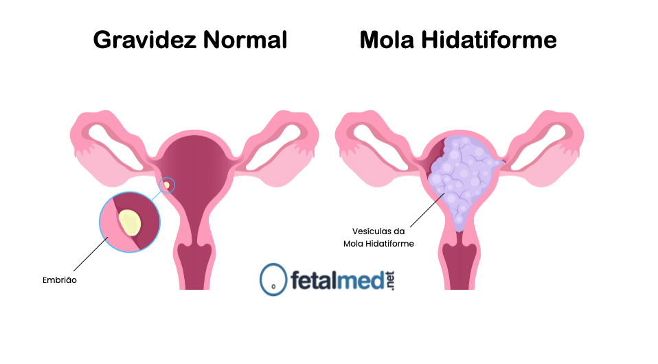 Gravidez Normal e Mola Hidatiforme