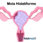 Tudo sobre Mola Hidatiforme