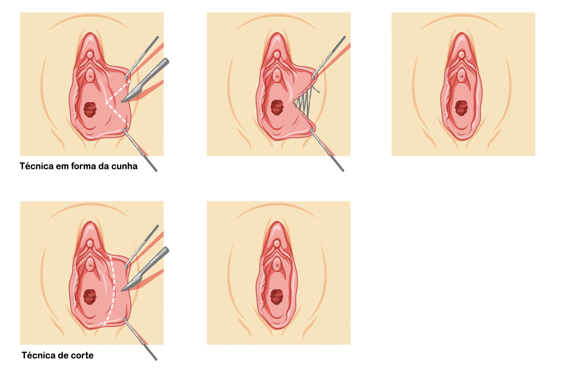 Técnicas de Ninfoplastia