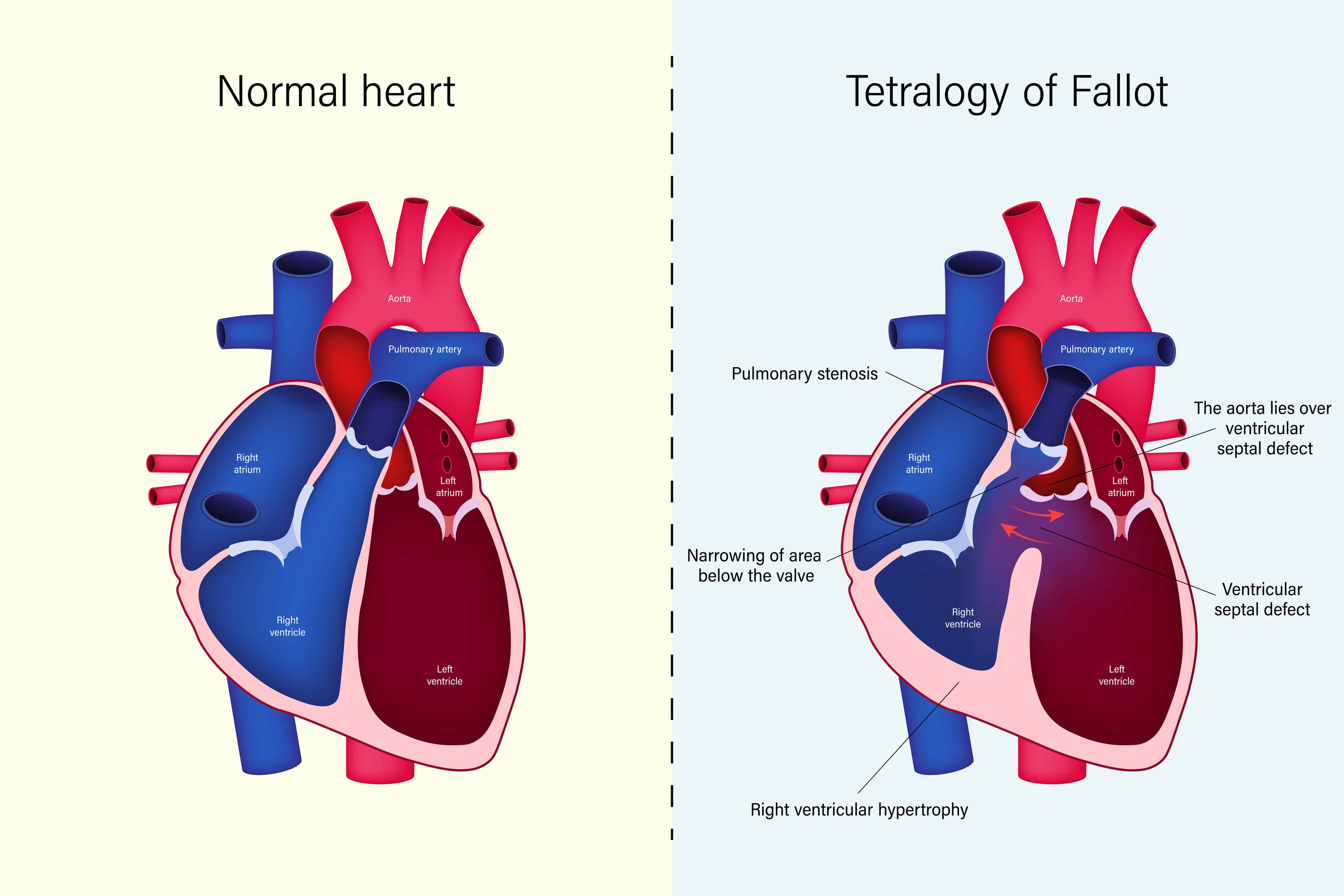 Tetralogia de Fallot