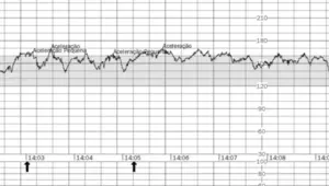 Cardiotocografia anteparto com tracado de frequencia cardiaca fetal e aceleracoes - monitoramento fetal na Fetalmed Curitiba