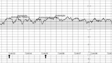 Cardiotocografia anteparto com tracado de frequencia cardiaca fetal e aceleracoes - monitoramento fetal na Fetalmed Curitiba