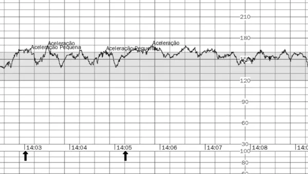 Cardiotocografia anteparto com tracado de frequencia cardiaca fetal e aceleracoes - monitoramento fetal na Fetalmed Curitiba
