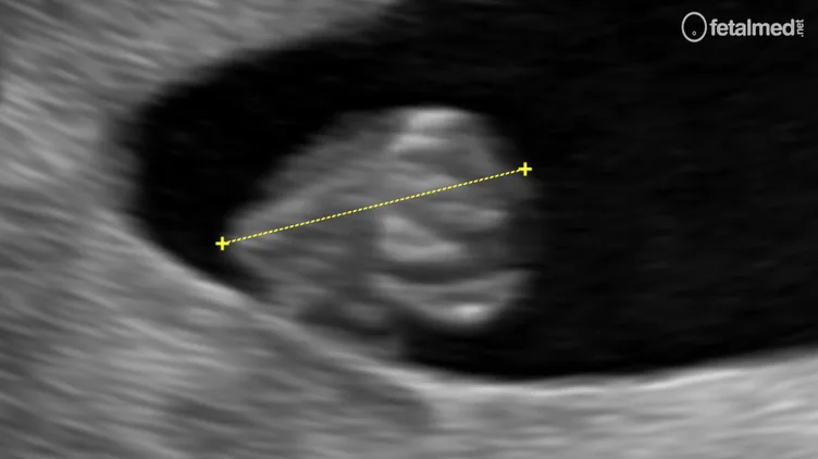 Medida do comprimento cabeça-nádegas CCN ao ultrassom transvaginal no primeiro trimestre da gestação