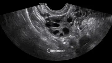 Ultrassom transvaginal para controle de ovulacao mostrando foliculos ovarianos - monitoramento de fertilidade na Fetalmed Curitiba