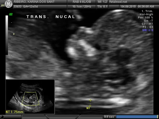 Translucência Nucal - 12a semana de gravidez | Fetalmed