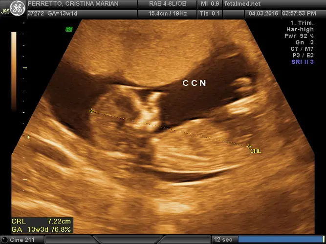 Feto de 13 semanas - 13a semana de gravidez | Fetalmed