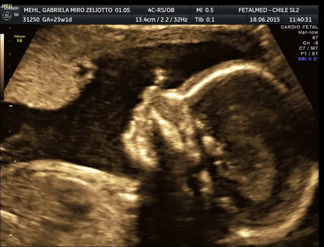 Ultrassom Perfil Fetal - 22a semana de gravidez | Fetalmed