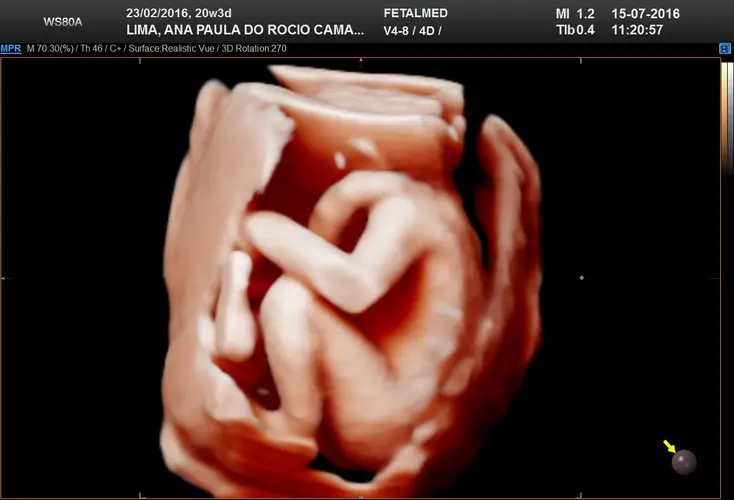 Ultrassom 3D Feto de 23 semanas - 23a semana de gravidez | Fetalmed