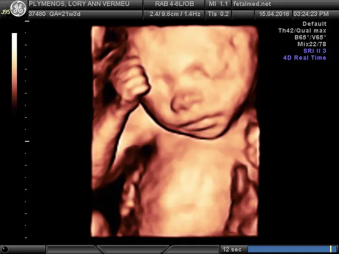 Ultrassom Face Fetal 3D - 24a semana de gravidez | Fetalmed