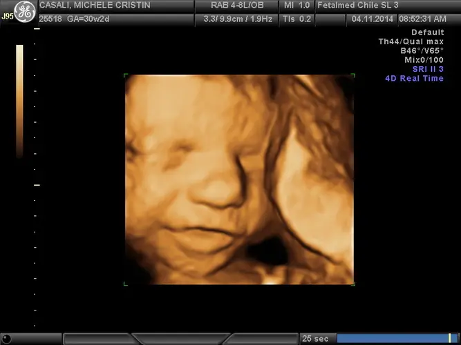 Ultrassom 3D face Fetal - 26a semana de gravidez | Fetalmed