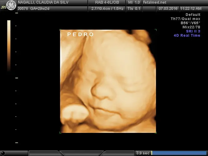 Ultrassom 3D Face Bebe - 28a semana de gravidez | Fetalmed