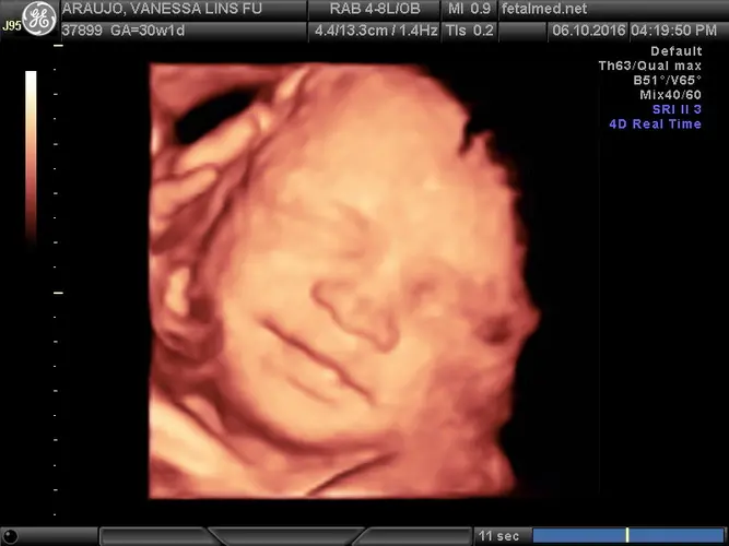 Ultrassom 3D face Fetal - 30a semana de gravidez | Fetalmed