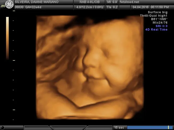Ultrassom 3D face Fetal - 31a semana de gravidez | Fetalmed