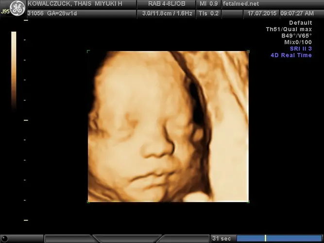 Ultrassom 3D face Fetal - 32a semana de gravidez | Fetalmed