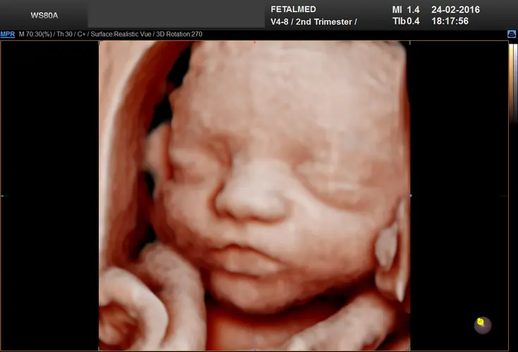 Ultrassom 3D face Fetal - 33a semana de gravidez | Fetalmed
