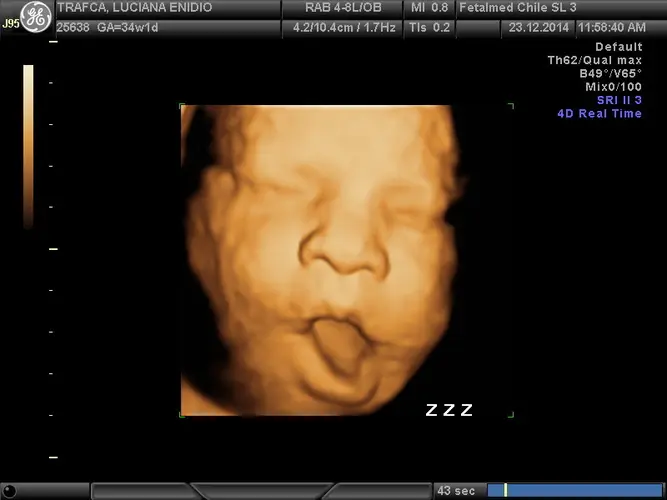 Feto bocejando ultrassom 3D - 34a semana de gravidez | Fetalmed